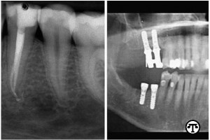 Radiograph of a natural tooth after root canal treatment (left) and extracted teeth replaced with dental implants (right). Courtesy of the American Association of Endodontists. 