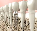 Tooth implant using advance dental technology