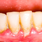 brushing your teeth focused on the gum disease prevention.