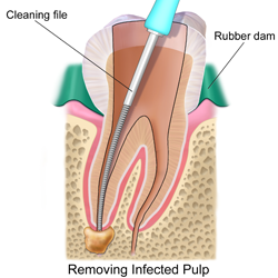 Root Canal Treatment procedure 