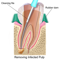 root canal procedure