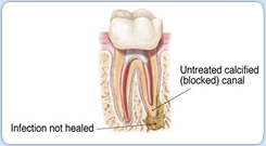 Root Canal Retreatment