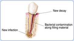 Root Canal Retreatment Procedure