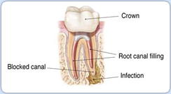 Root Canal Retreatment Procedure