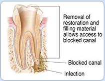 Endodontic Retreatment