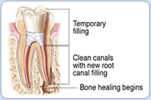 Endodontic Retreatment Procedure