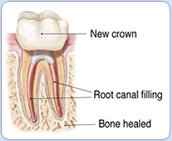 Root Canal Retreatment Procedure