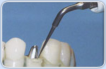 Ultrasonic Instruments for Root Canal Treatment