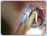 Ultrasonic Endodontic Equipment